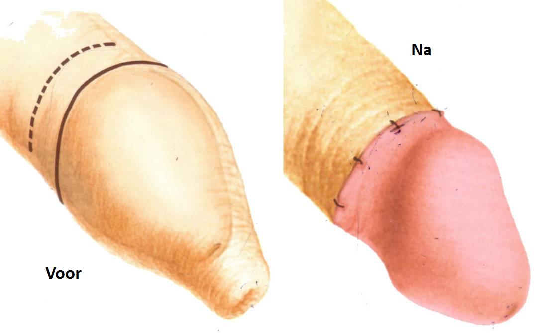 Materialele plastice ale frenulului penisului